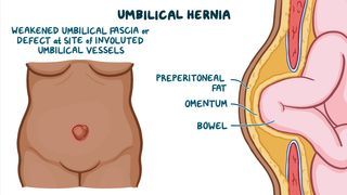Umbilical hernias: Clinical sciences