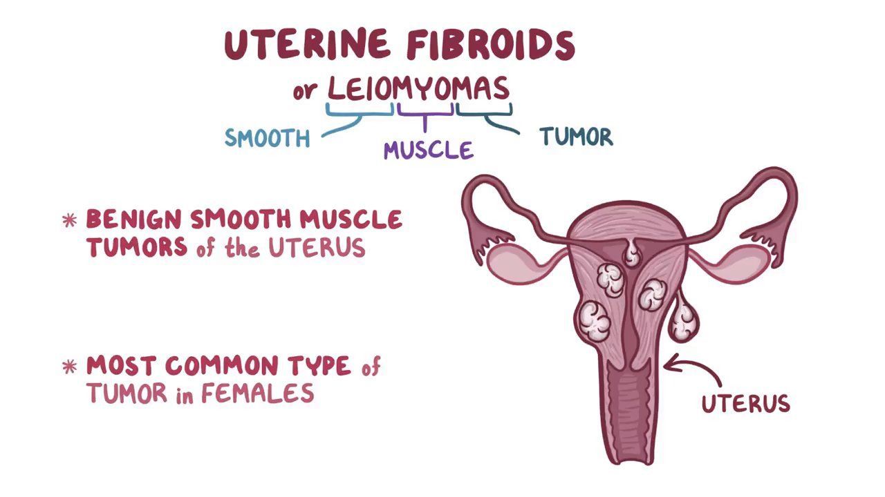 Intramural myomas more than 3–4 centimeters should be surgically removed  before in vitro fertilization - Fertility and Sterility, image size:1280x720