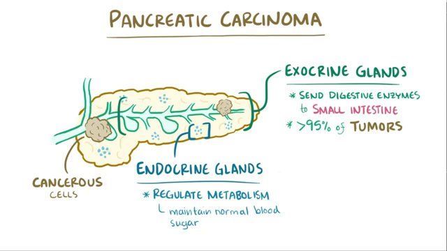 Pancreatic Cancer Osmosis