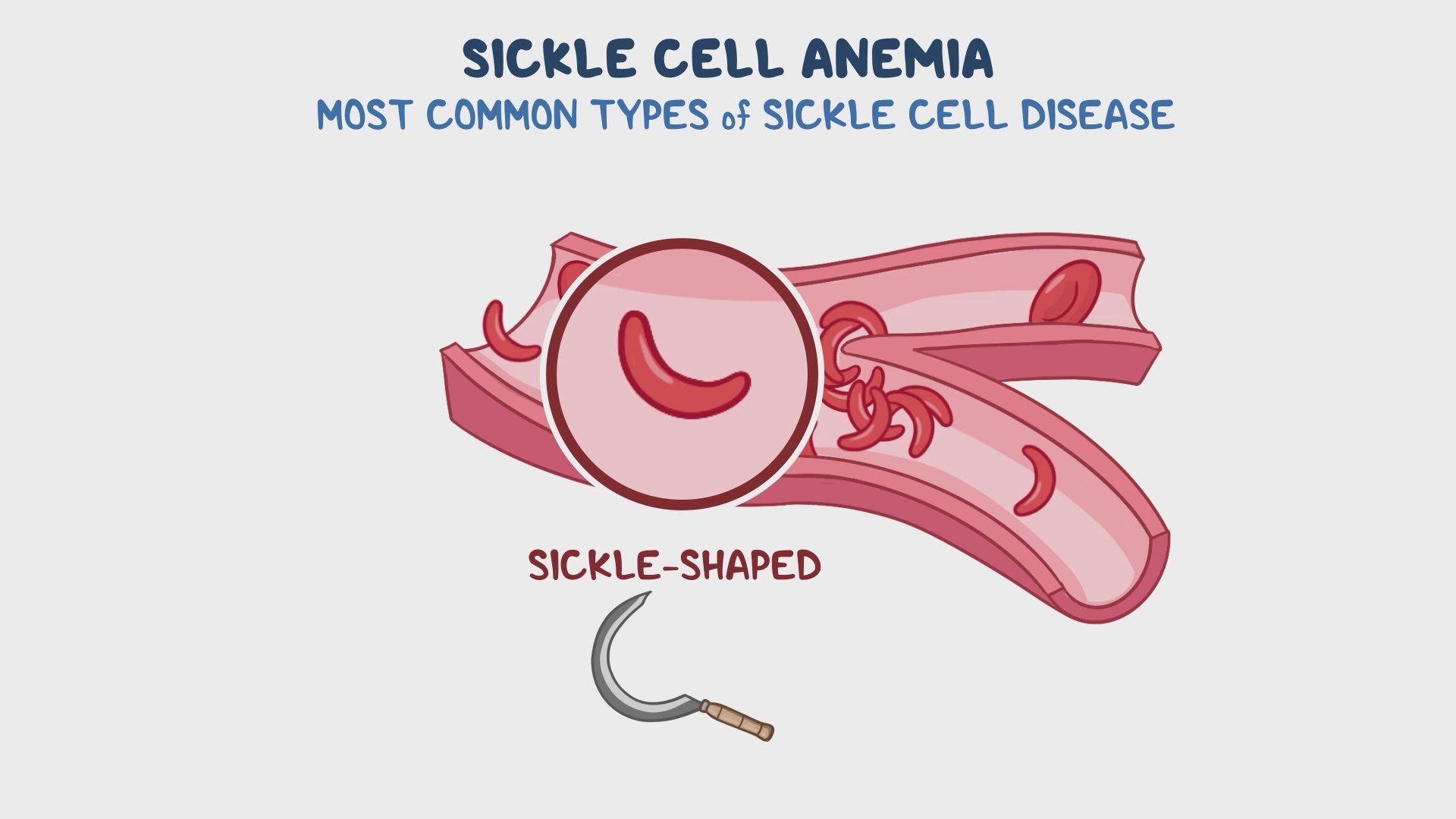 Video: Sickle cell anemia: Nursing pathophysiology | Osmosis