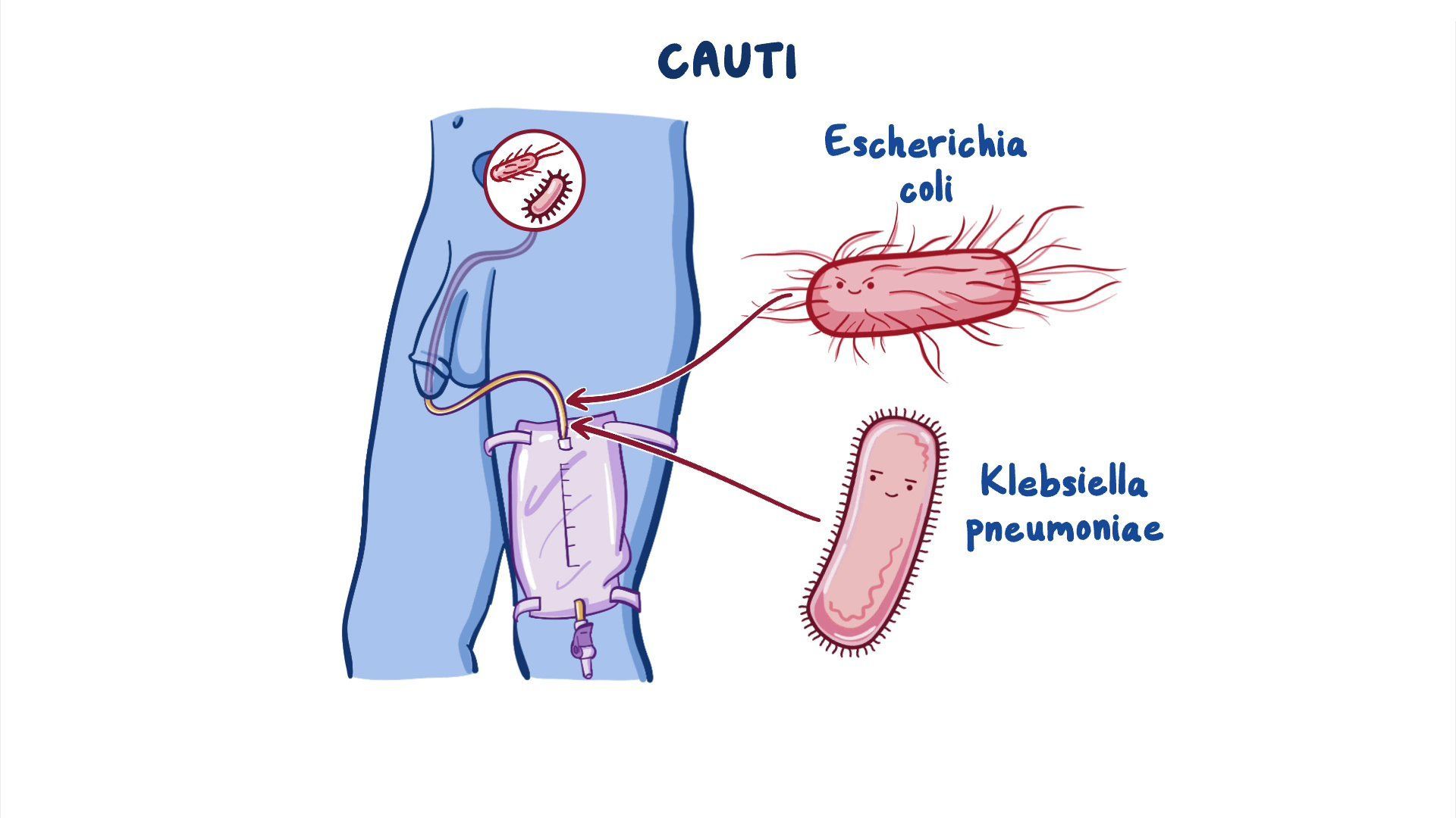Video Catheter associated Urinary Tract Infection Clinical Sciences